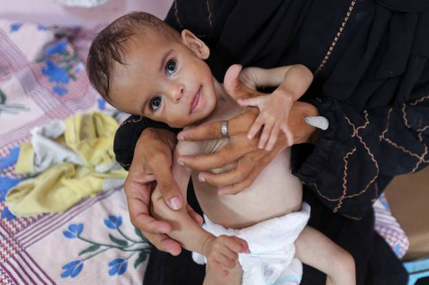 Malnourished Palestinian girl Seela Barbakh receives treatment at Nasser Hospital in Khan Younis, in the southern Gaza Strip