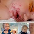 'Poljubac smrti': Dvogodišnjak završio u bolnici zbog herpesa