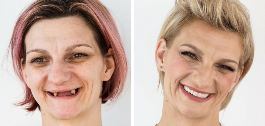 Razbijamo popularne mitove o implantatima