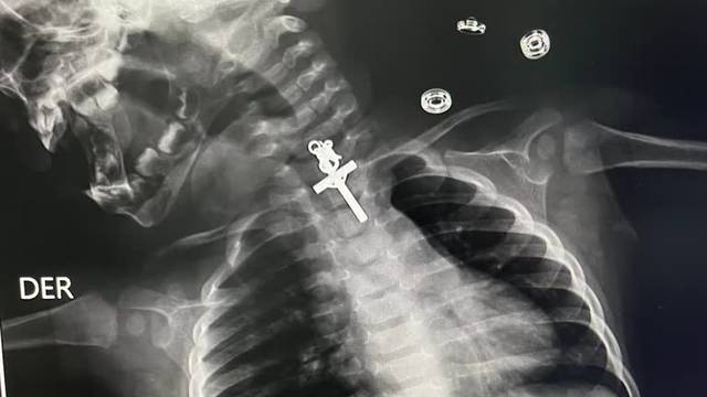 Shocking X-ray shows crucifix stuck in Peruvian child's throat