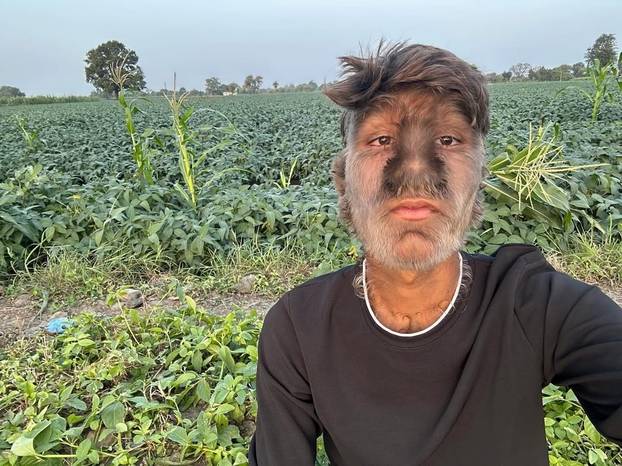 FOTO Ovaj mladić (18) pati od sindroma vukodlaka: U školi me sprdaju, ali volim svoje dlake...