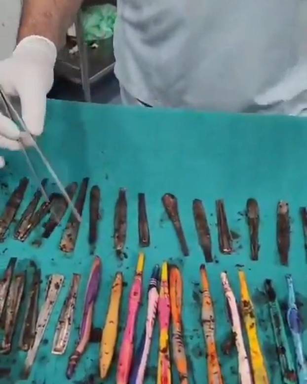 VIDEO: Doctors remove 28 spoons and 19 toothbrushes from man’s stomach