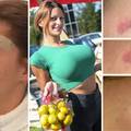 Na istog se estetskog kirurga žalila i Kristina Mandarina. Pogledajte kako je izgledala