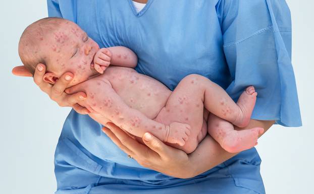 Newborn baby which is sick rubella or measles