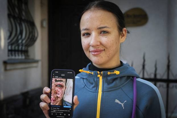 Former Ukrainian service member, who was wounded at a front line, comes to a clinic to treat scars, in Lviv