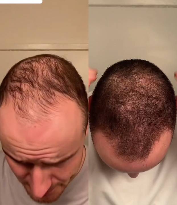 FOTO Stručnjaci o presađivanju kose: 'U Turskoj je to bilo dosta sumnjive kvalitete...'