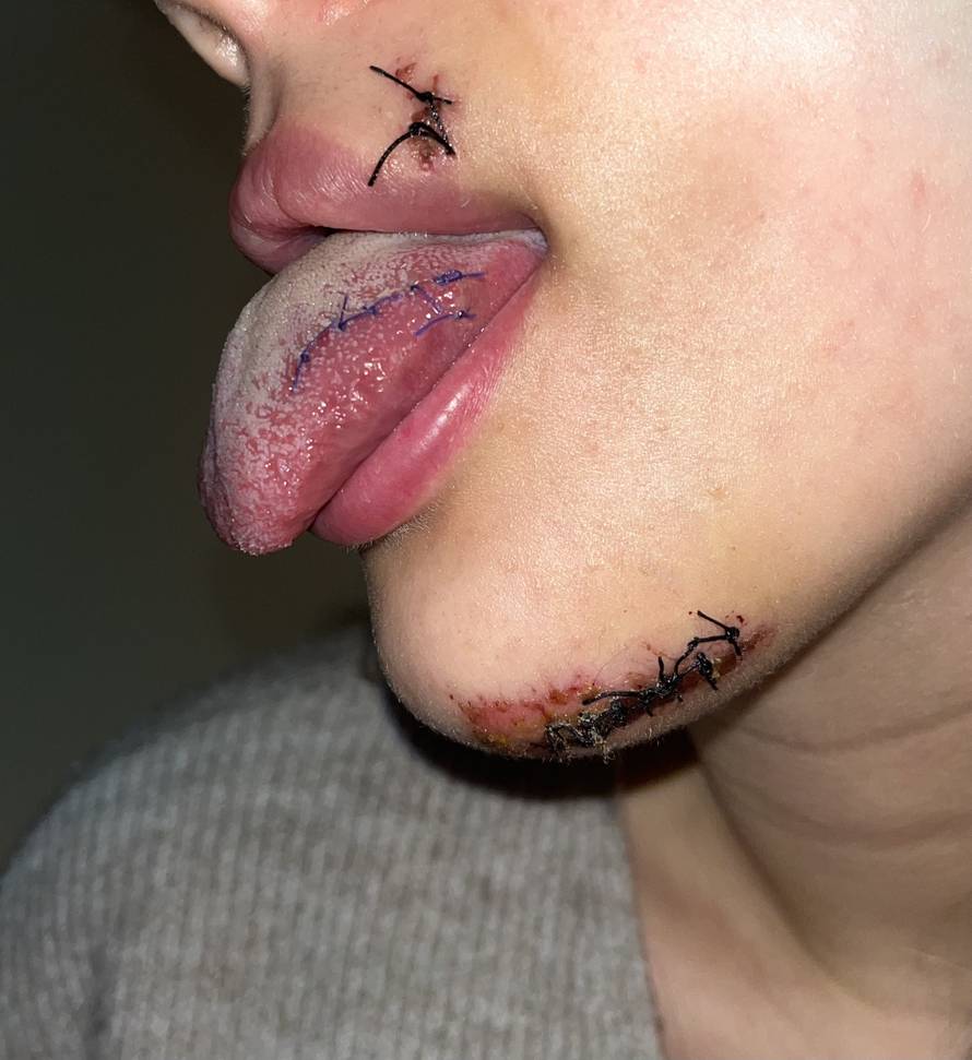 Zagrepčane prebili u Beogradu: 'Krivo su mi zašili jezik. Tukli su i šogora. Jedva jede od bolova'