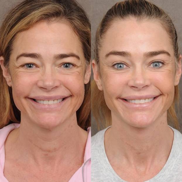 Denise Richards na faceliftingu: Sheenova bivša pokazala je fotke prije i poslije zahvata