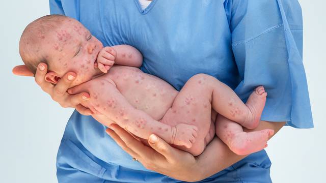 Majčin imunitet štiti bebe od ospica samo prva tri mjeseca