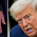 Trump pregledan zbog oticanja nogu i modrica: 'Predsjednik ima kroničnu bolest vena...'