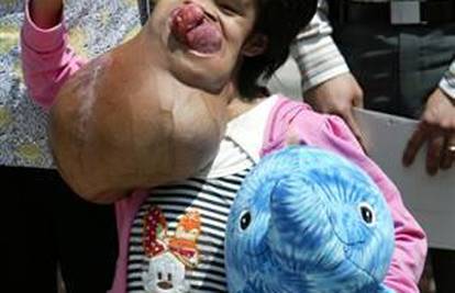 Vijetnamki (15) otklonili tumor od sedam kila s lica