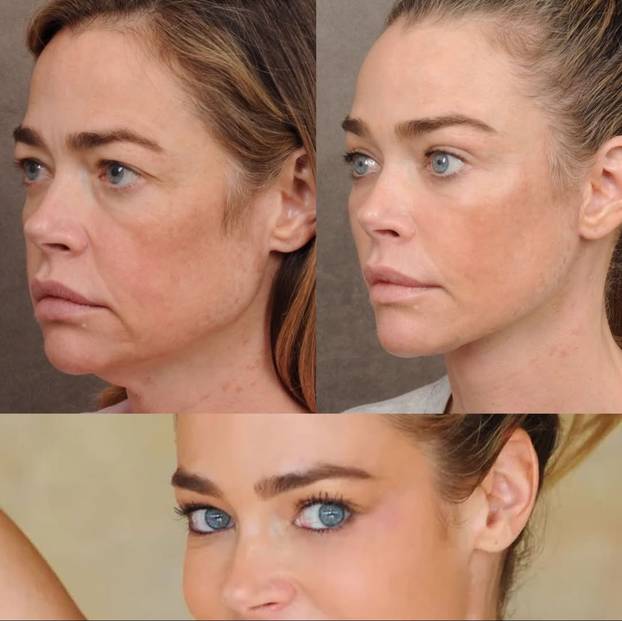 Denise Richards na faceliftingu: Sheenova bivša pokazala je fotke prije i poslije zahvata