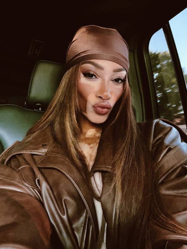 FOTO Rugali su joj se zbog bolesti, a danas je obožavaju zbog jedinstvenog izgleda