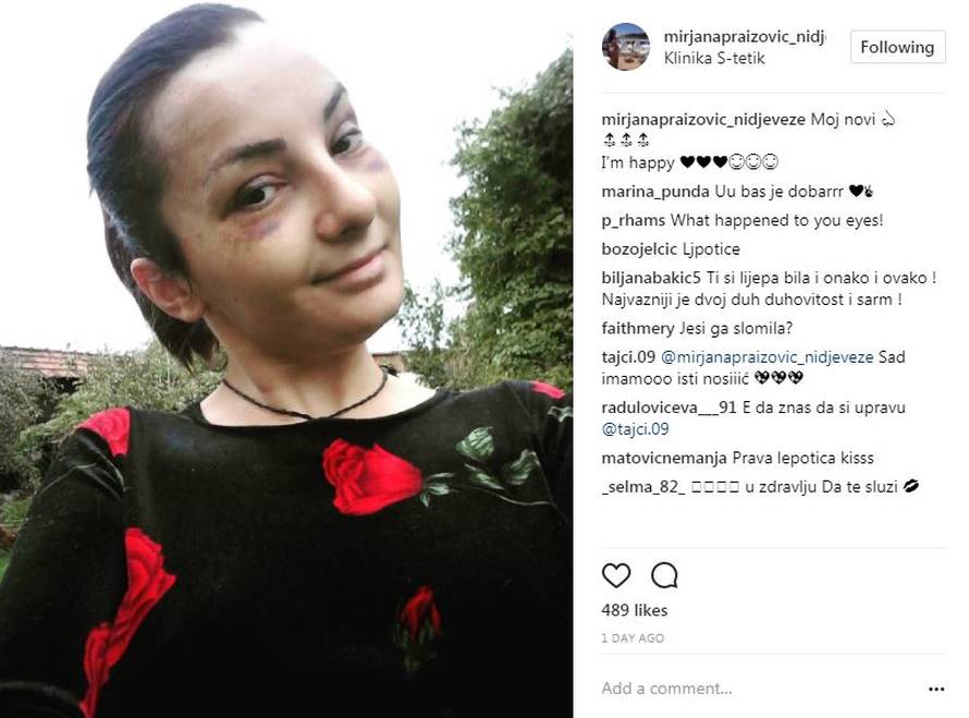 BB Mirjana smanjila nos: 'Što ti je s licem, ovo je strašno?!'