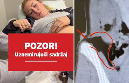 VIDEO Mikaela Shiffrin objavila grozne snimke ozljede: 'Skijaški štap umalo je probio organe'