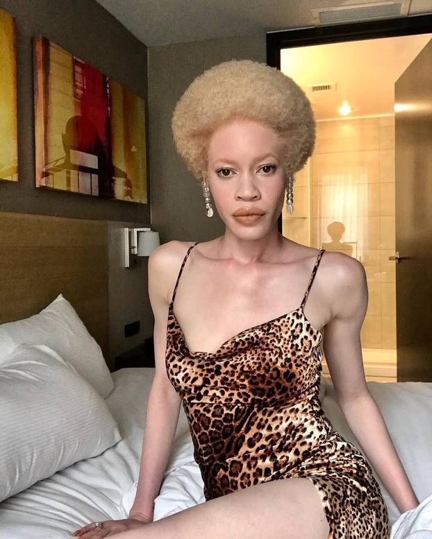 FOTO Afrikanka s albinizmom osvaja modnu industriju: 'Često privlačim znatiželjne poglede'