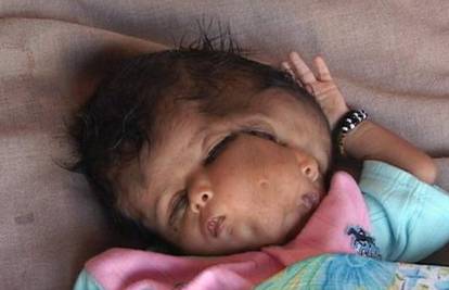 Indijska 'božica' s dva lica umrla je zbog deformacije