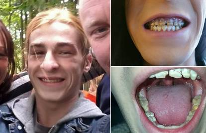 Mladić (21) je zagrizao jabuku pa mu pukla četiri prednja zuba