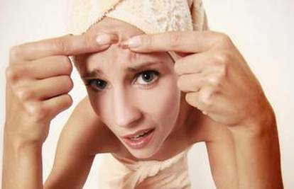Lakovi za kosu, hormoni i frizure mogu izazvati akne