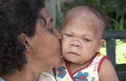 Žena od 30 godina zatočena u tijelu bebe, ne može ni govoriti