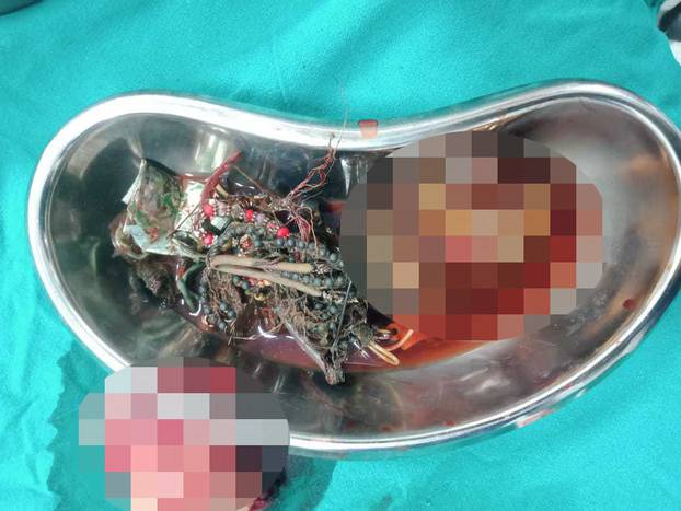EXCLUSIVE: Man who had tummy ache for TWO YEARS had eaten over 60 items including earphones, screws and buttons