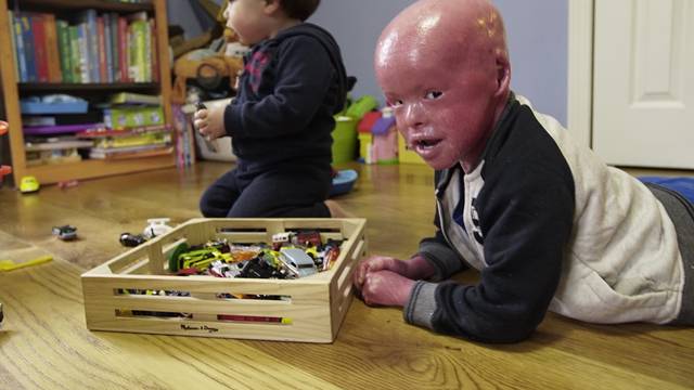 Harlequin Ichthyosis: The Boy Whose Skin Grows Too Fast