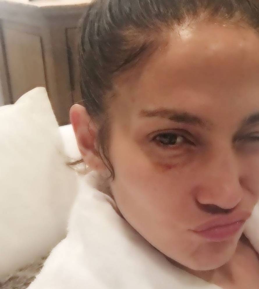 Posao može biti opasan: Lopez je pokazala masnicu ispod oka