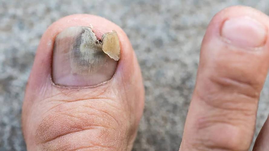 Recite zbogom gljivicama na noktima i obući – kombinacija koja stvarno djeluje