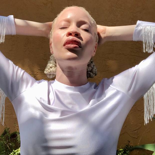 FOTO Afrikanka s albinizmom osvaja modnu industriju: 'Često privlačim znatiželjne poglede'