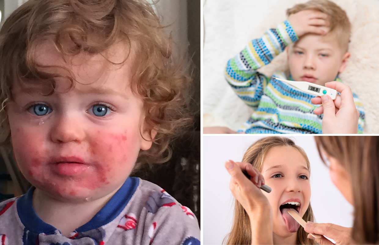 Domaći pedijatri objasnili kako prepoznati razliku između Pete i Šeste bolesti te streptokoka