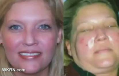 Laserom je htjela ukloniti venu, a kozmetičarka joj 'spalila' lice