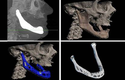 Izradili čeljust 3D printerom i uspješno je ugradili ženi (83)