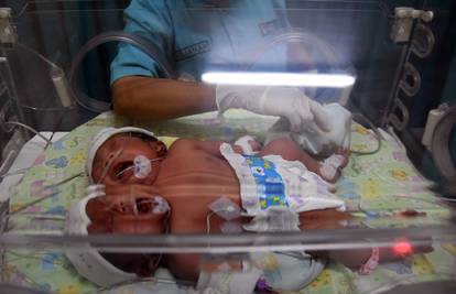 U inkubatoru na aparatima: Rodila se curica s dvije glave