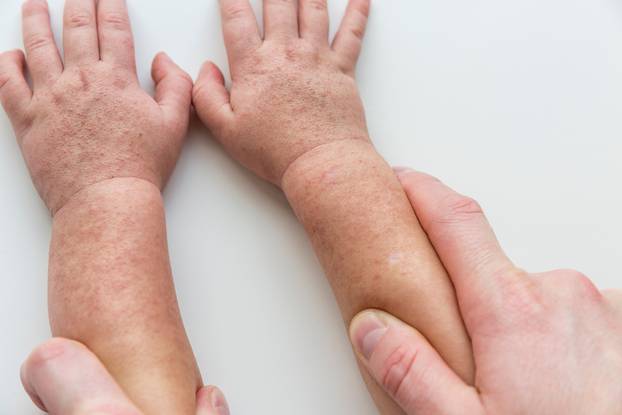 Scarlet fever. Two children's hands with rash on white backgroun