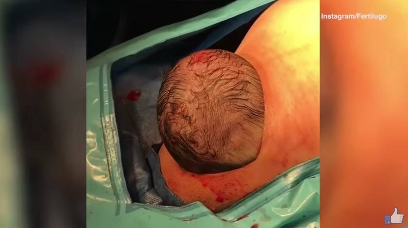 Nova era carskog reza: Beba sama izlazi iz majčine utrobe