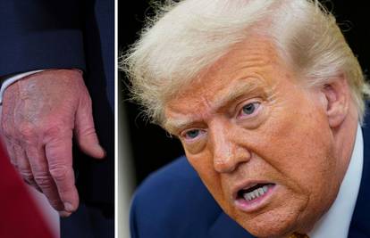 Trump pregledan zbog oticanja nogu i modrica: 'Predsjednik ima kroničnu bolest vena...'