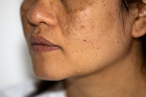 Young,Asian,Women,Having,A,Skin,Problem,With,Melasma,And