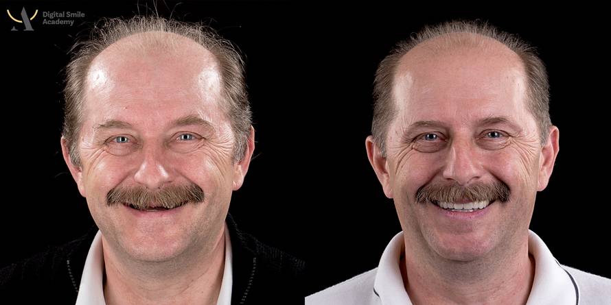 Osmijeh kao iz filma: Možete vidjeti prije kako ćete izgledati