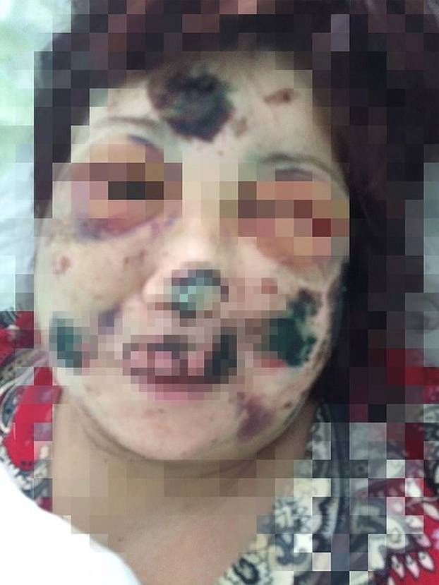 [MUZZED] Russian Hannibal Lecter left a dinner date horrifically disfigured after biting off her ears, nose and fingertips. 