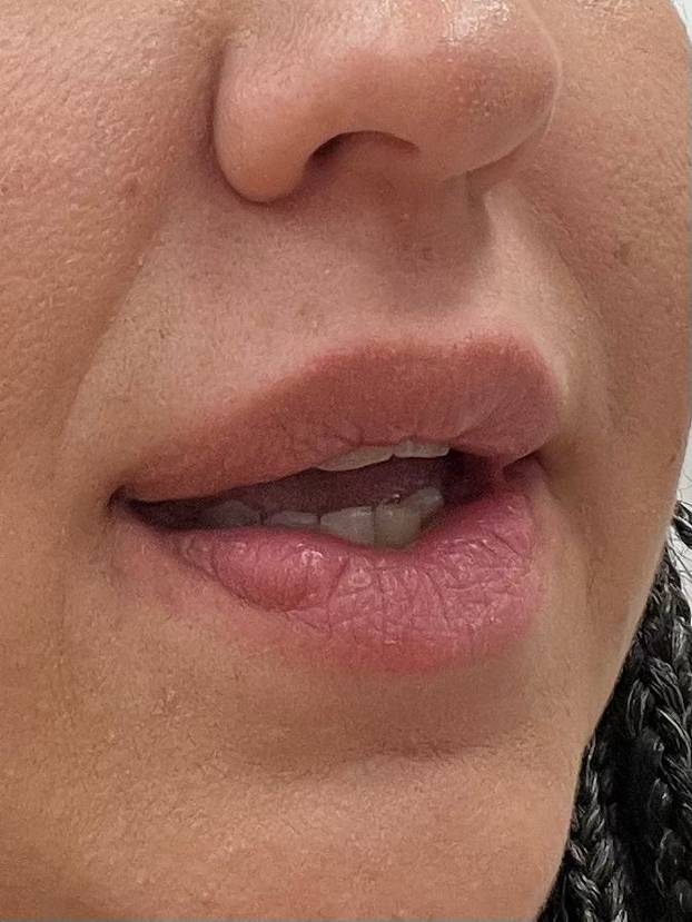 Na istog se estetskog kirurga žalila i Kristina Mandarina. Pogledajte kako je izgledala