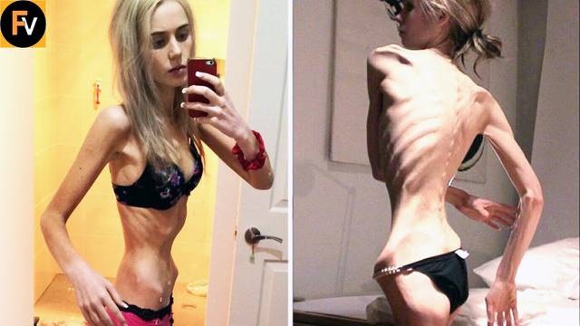 Osam najšokantnijih slučajeva anoreksije: Uočite i pomozite!