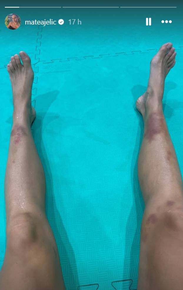FOTO Zlatna hrvatska olimpijka šokirala mnoge. Ovako joj noge izgledaju nakon treninga...