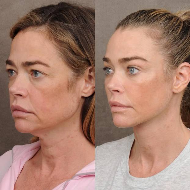 Denise Richards na faceliftingu: Sheenova bivša pokazala je fotke prije i poslije zahvata