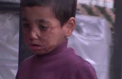 Teška sudbina malog Sirijca: Projektil mu je unakazio lice