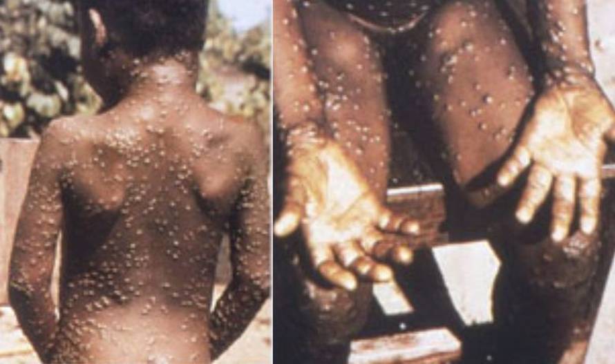 Slučajevi majmunskih boginja potvrđeno čak u 12 zemalja