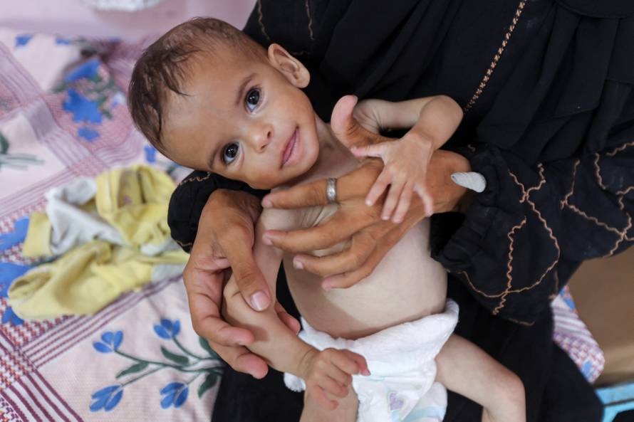 Malnourished Palestinian girl Seela Barbakh receives treatment at Nasser Hospital in Khan Younis, in the southern Gaza Strip