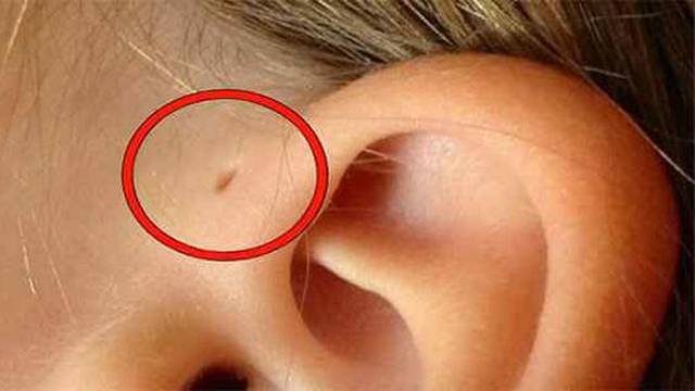 Znate li zašto neki ljudi imaju rupicu kraj uha - a drugi ne?