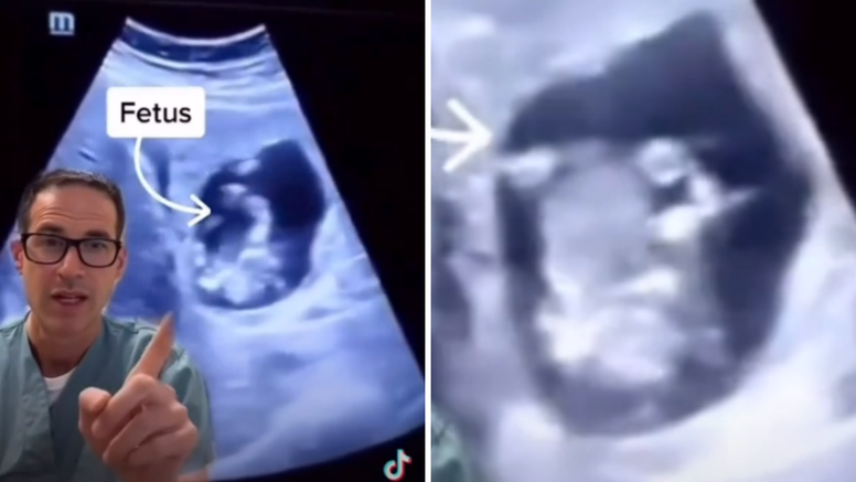 U jetri joj otkrili fetus djeteta; Doktor: 'Ovo nisam nikad vidio'