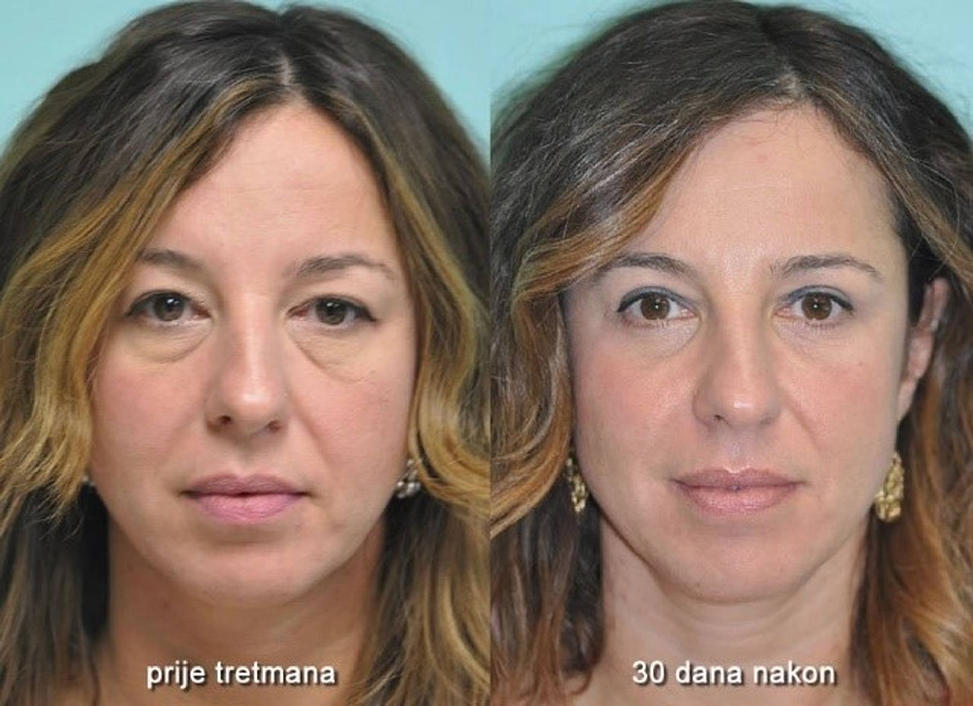 безинъекционная блефаропластика век. блефаропластика век в москве.