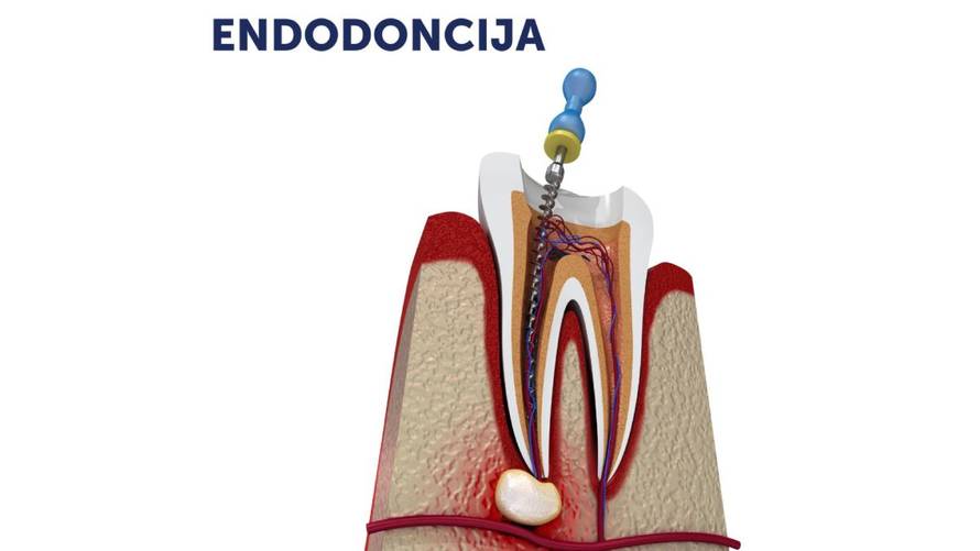 Značaj specijalista za korijenske kanale u stomatologiji